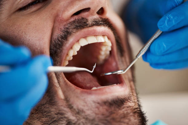 Best Emergency Wisdom Teeth Removal in Nokomis, FL